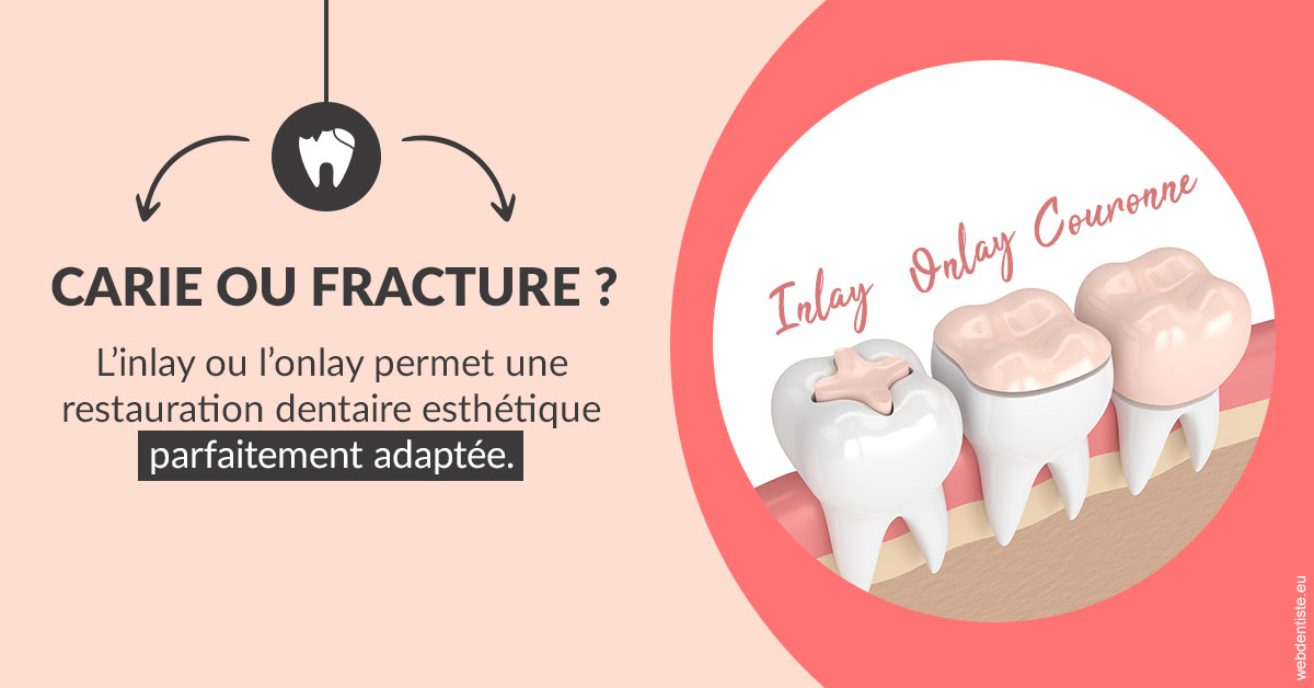 https://dr-kebir-quelin-myriam.chirurgiens-dentistes.fr/T2 2023 - Carie ou fracture 2