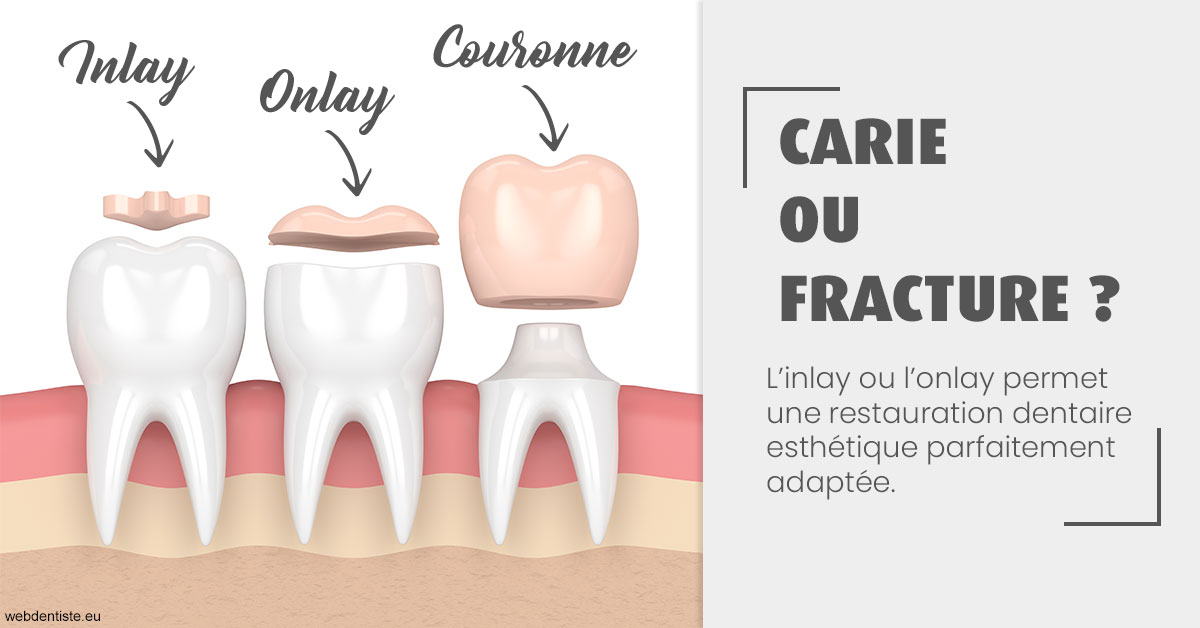 https://dr-kebir-quelin-myriam.chirurgiens-dentistes.fr/T2 2023 - Carie ou fracture 1