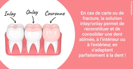 https://dr-kebir-quelin-myriam.chirurgiens-dentistes.fr/L'INLAY ou l'ONLAY 2